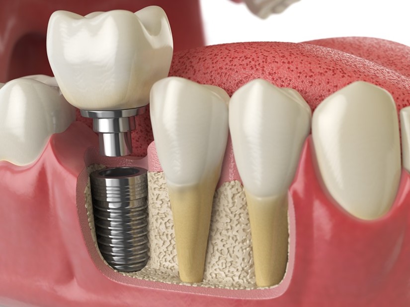 Todo Lo Que Debes Saber Acerca Los Implantes Dentales